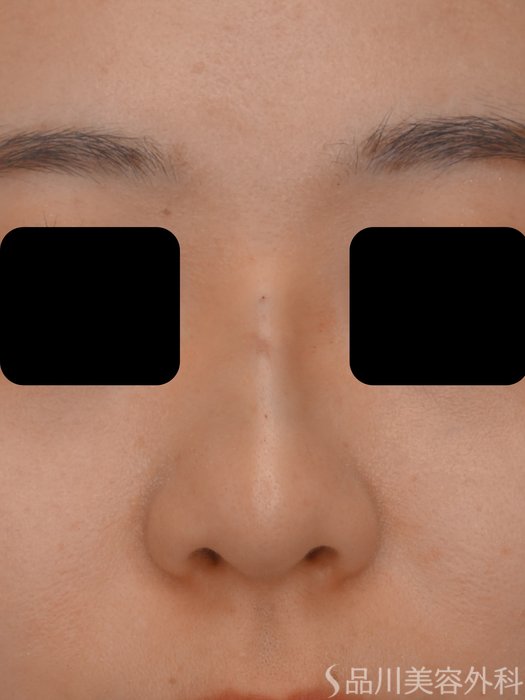 症例NO.73467のAFTER写真