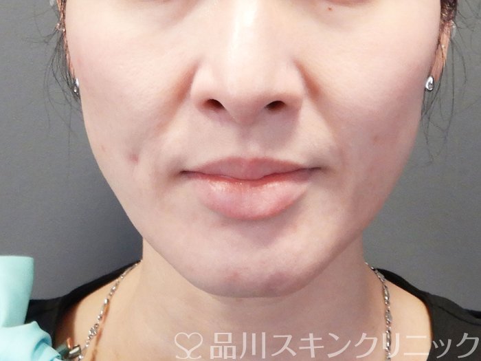 症例NO.72369のBEFORE写真