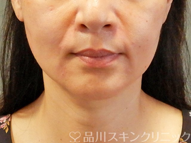 症例NO.66748のAFTER写真