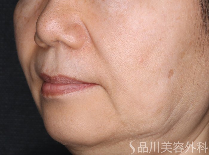 症例NO.72360のBEFORE写真