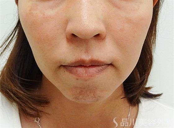 症例NO.36174のBEFORE写真