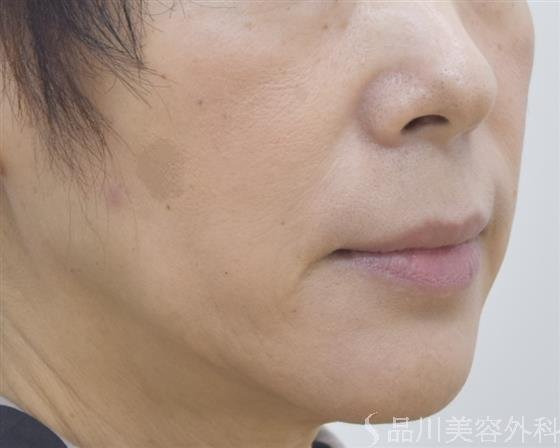 症例NO.45358のBEFORE写真