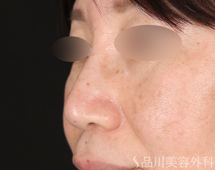 症例NO.72261のAFTER写真