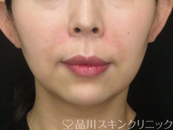 症例NO.69827のAFTER写真