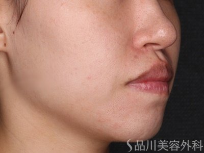 症例NO.73331のBEFORE写真