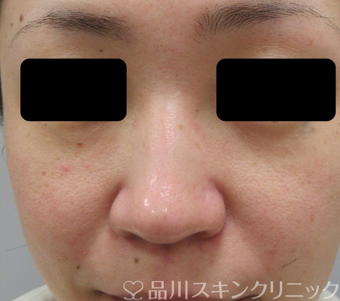 症例NO.74117のBEFORE写真