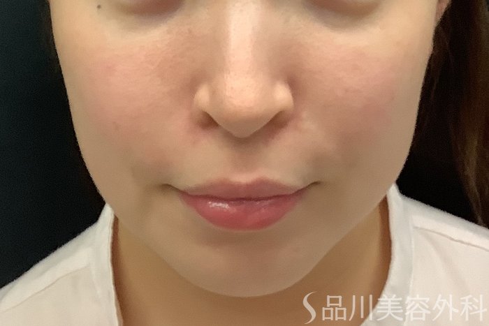 症例NO.71243のBEFORE写真