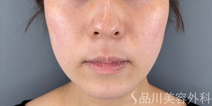 症例NO.71960のBEFORE写真