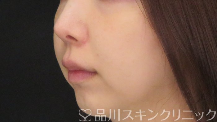 症例NO.71769のBEFORE写真