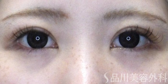 症例NO.70478のAFTER写真