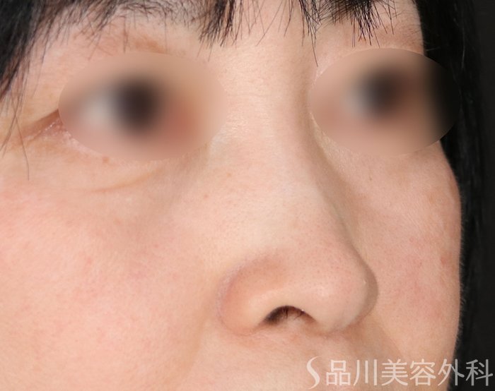 症例NO.74207のBEFORE写真