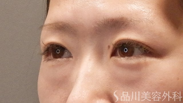 症例NO.73677のBEFORE写真