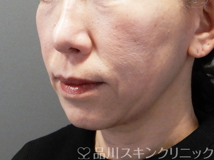 症例NO.73575のAFTER写真