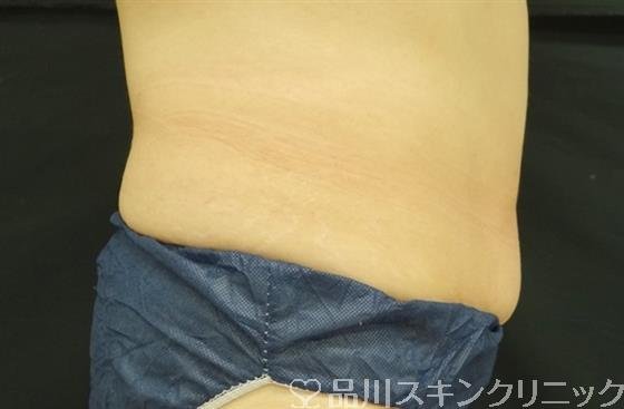 症例NO.49488のBEFORE写真