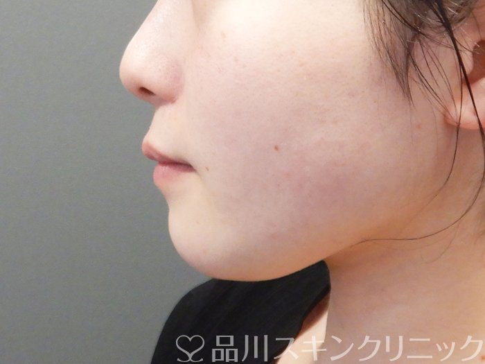 症例NO.72522のBEFORE写真