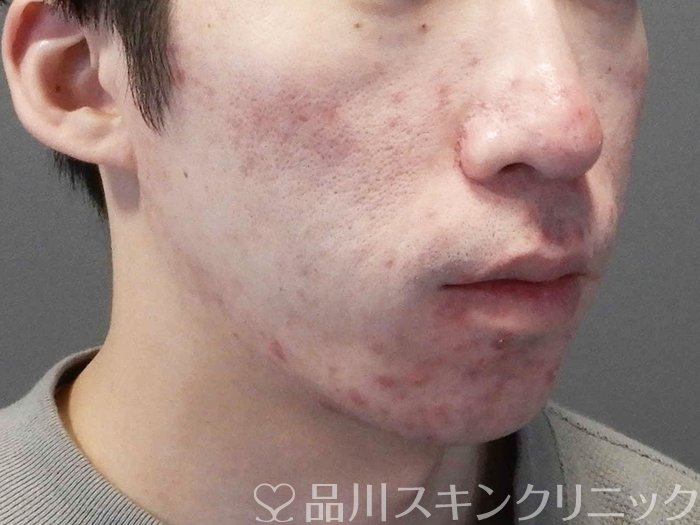 症例NO.69645のBEFORE写真
