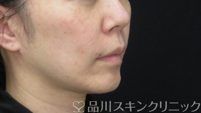 症例NO.72330のBEFORE写真