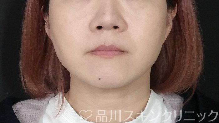 症例NO.72998のAFTER写真