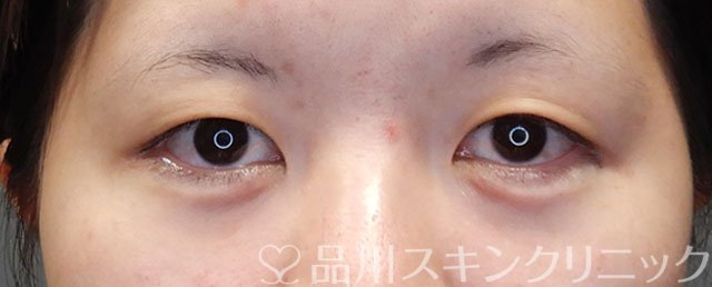症例NO.74493のAFTER写真