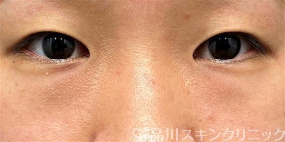 症例NO.61629のBEFORE写真