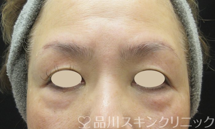 症例NO.69364のBEFORE写真
