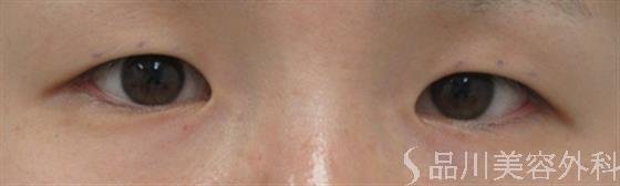 症例NO.27947のBEFORE写真