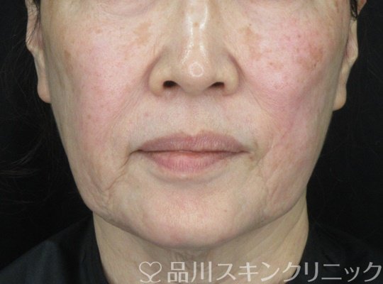 症例NO.69822のBEFORE写真