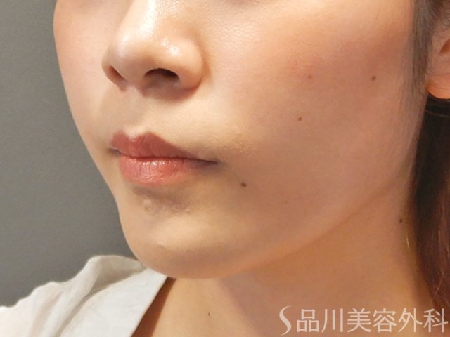 症例NO.71798のAFTER写真