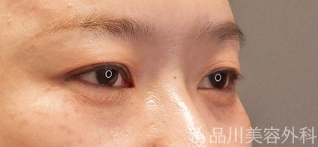 症例NO.72767のAFTER写真