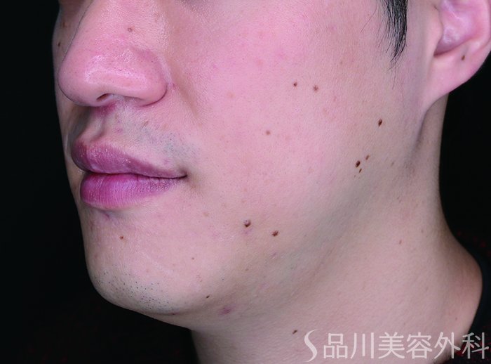 症例NO.72399のAFTER写真