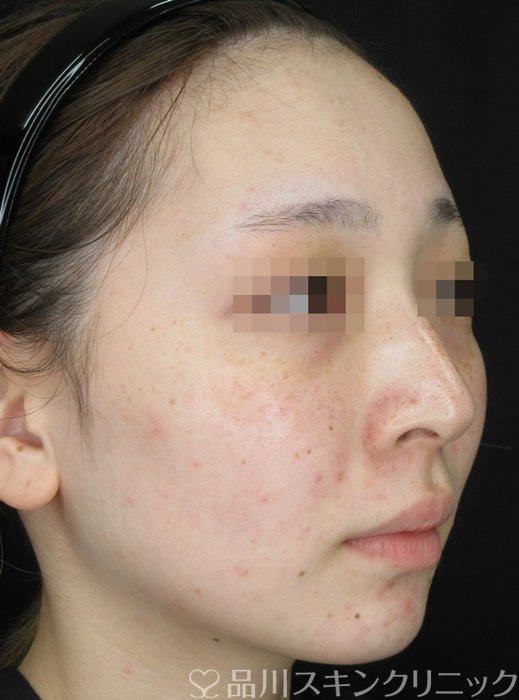 症例NO.70482のBEFORE写真