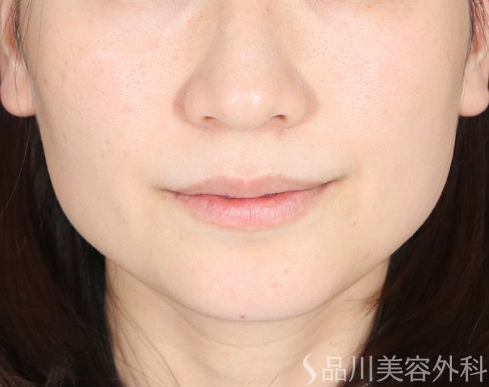 症例NO.73669のAFTER写真