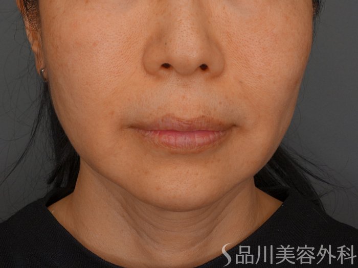 症例NO.62526のBEFORE写真