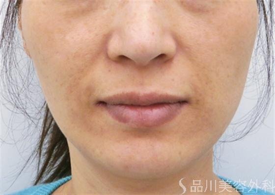 症例NO.18139のAFTER写真