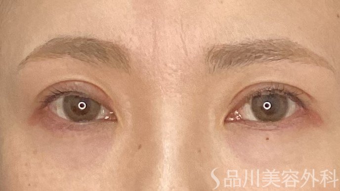 症例NO.71146のAFTER写真