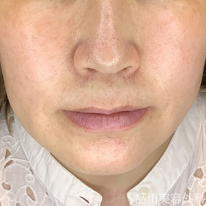 症例NO.62278のBEFORE写真