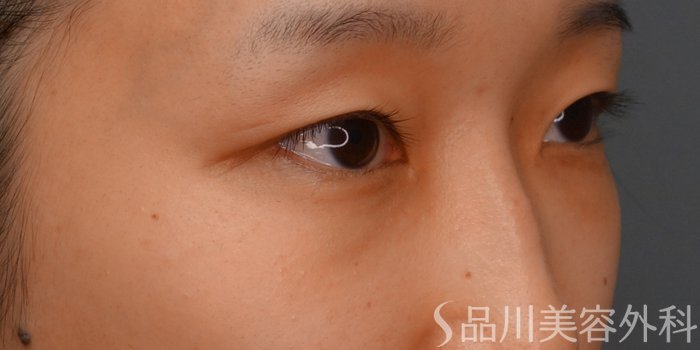 症例NO.74470のBEFORE写真