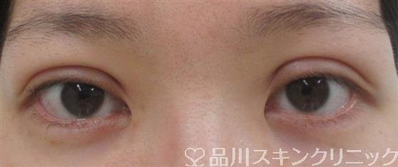 症例NO.27574のBEFORE写真