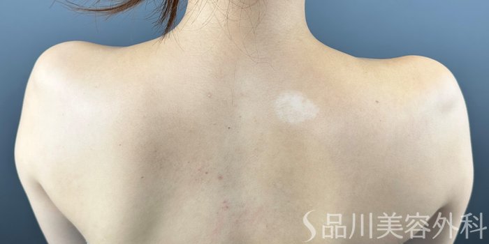 症例NO.71964のBEFORE写真