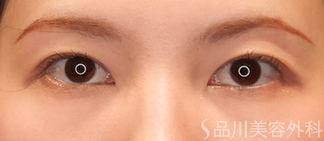 症例NO.72268のAFTER写真