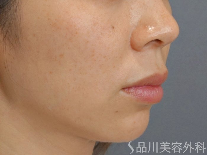 症例NO.73865のBEFORE写真