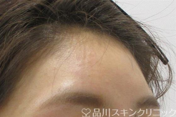 症例NO.32055のAFTER写真