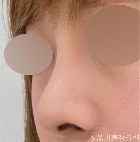 症例NO.24777のAFTER写真