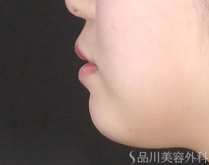 症例NO.65089のBEFORE写真