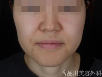 症例NO.73525のBEFORE写真