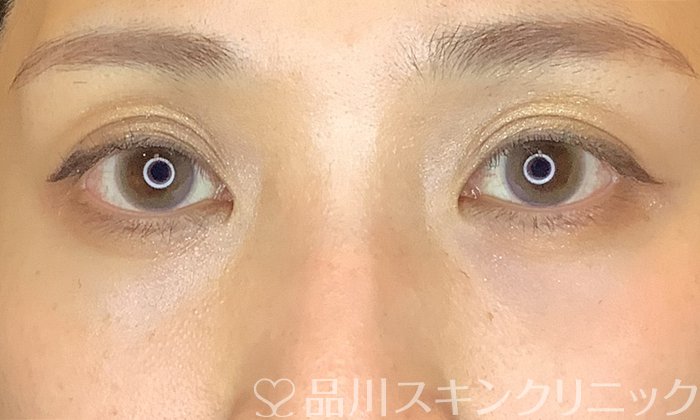 症例NO.72069のAFTER写真