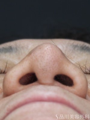 症例NO.73556のBEFORE写真