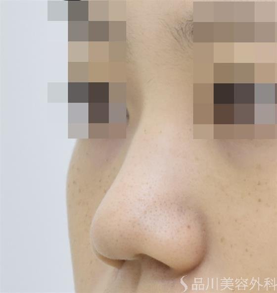 症例NO.44115のBEFORE写真