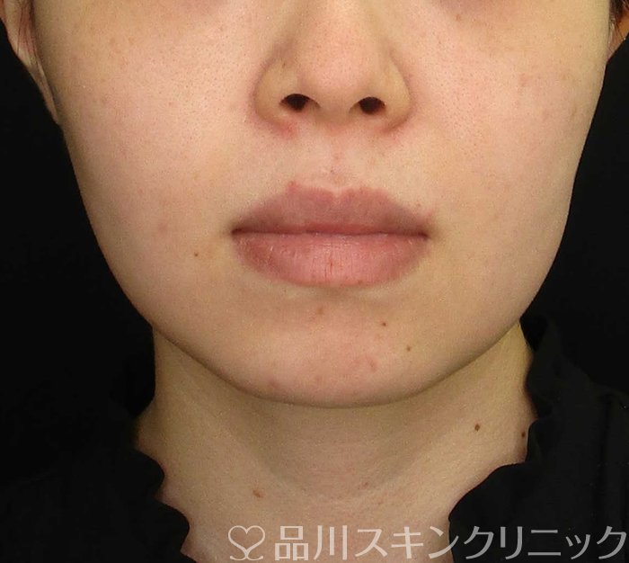 症例NO.70448のBEFORE写真