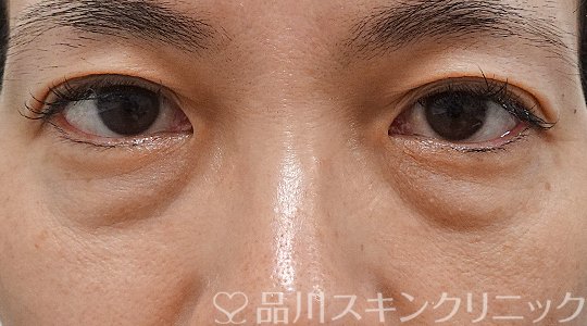 症例NO.63393のBEFORE写真
